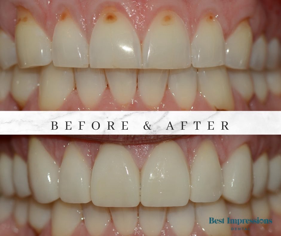Dental Crown Before and After